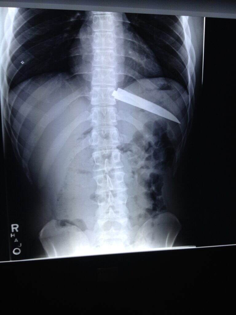A blade in the abdomen. Not normal in a smiling patient!