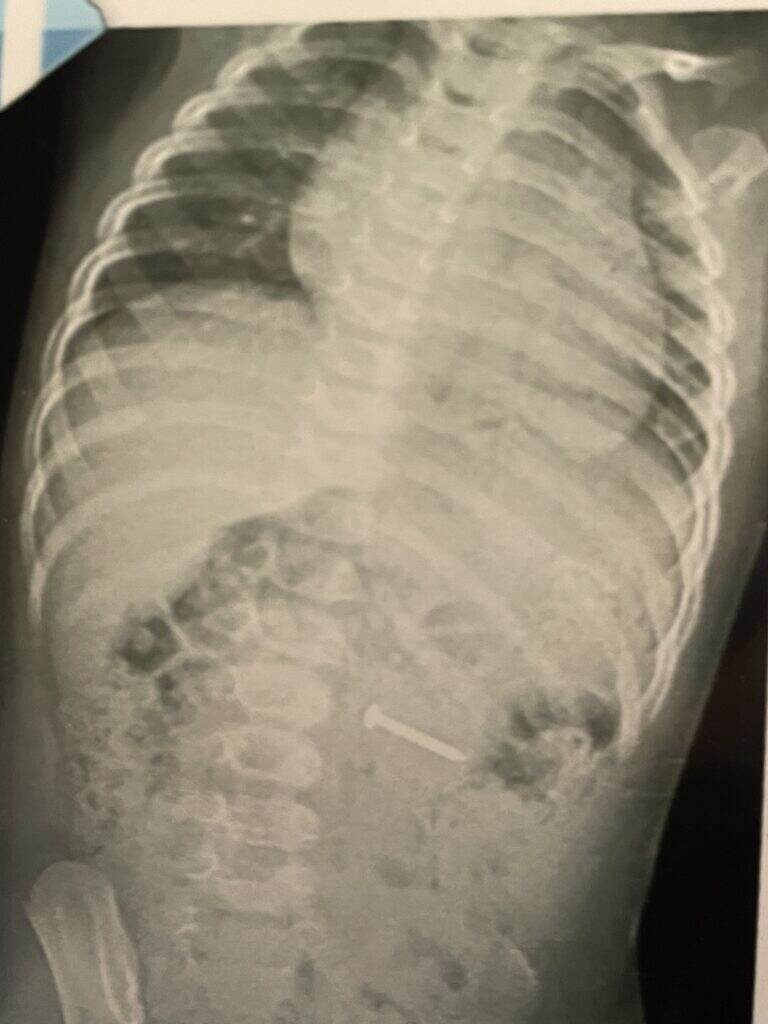 A babygram of a young fellow who swallowed a Pinewood Derby car axle.