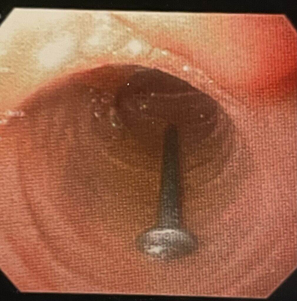 The nail as it lay in the duodenum before retrieval.