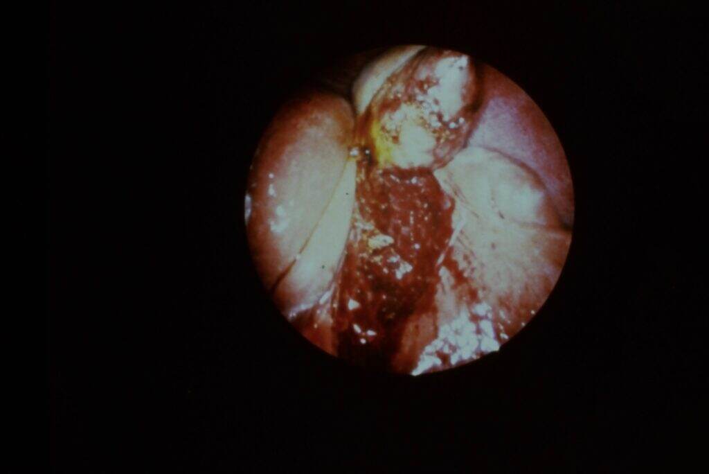 This was how laparoscopic gallbladder surgery looked in the early days, circa 1993.