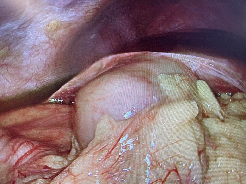 A severely inflamed gallbladder—but a wonderfully clear image.