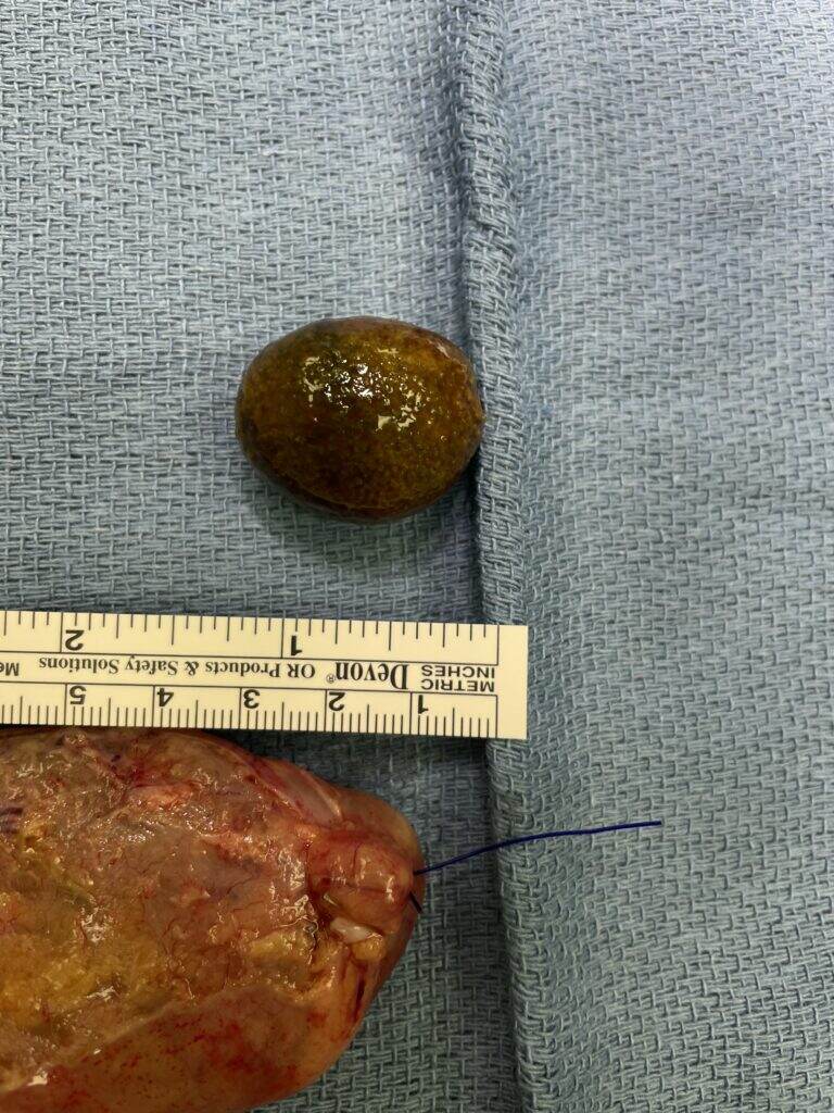 Gallstone next to a thickened gallbladder.