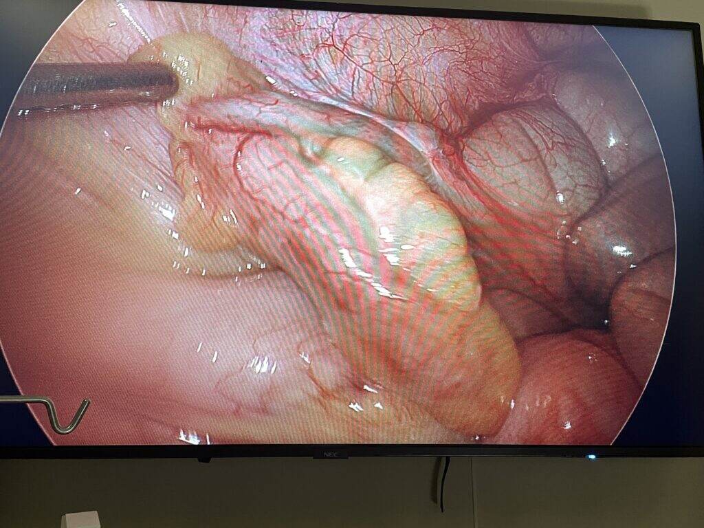 Appendicitis.