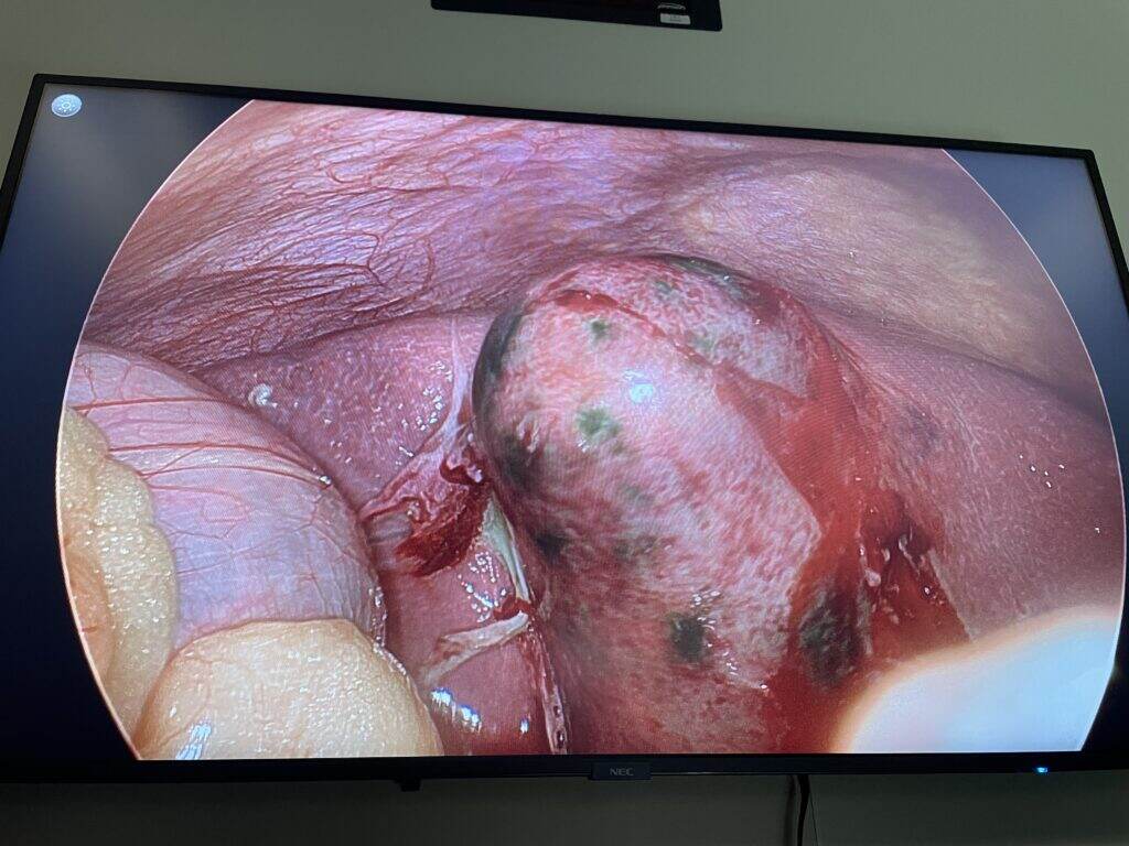 A swollen, gangrenous gallbladder.