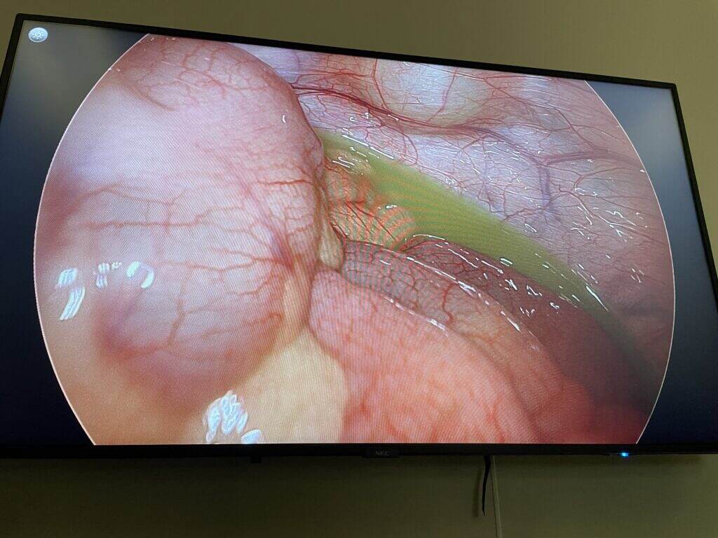 Pus in the pelvis.