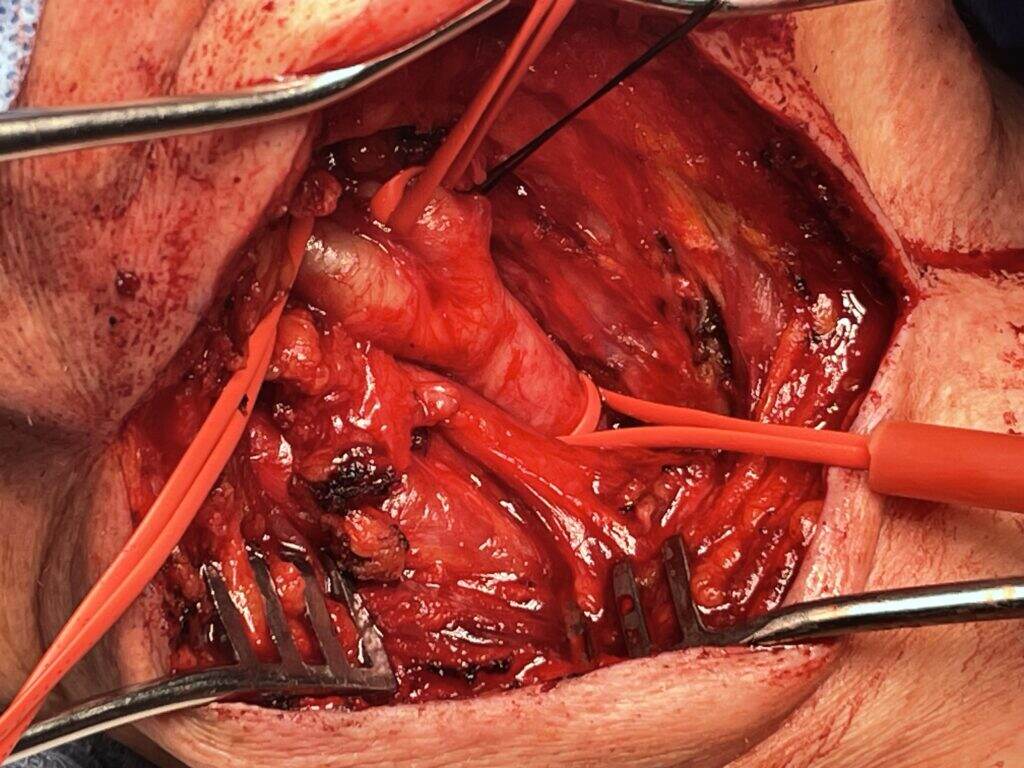 Exposure of the carotid artery to treat a blockage.