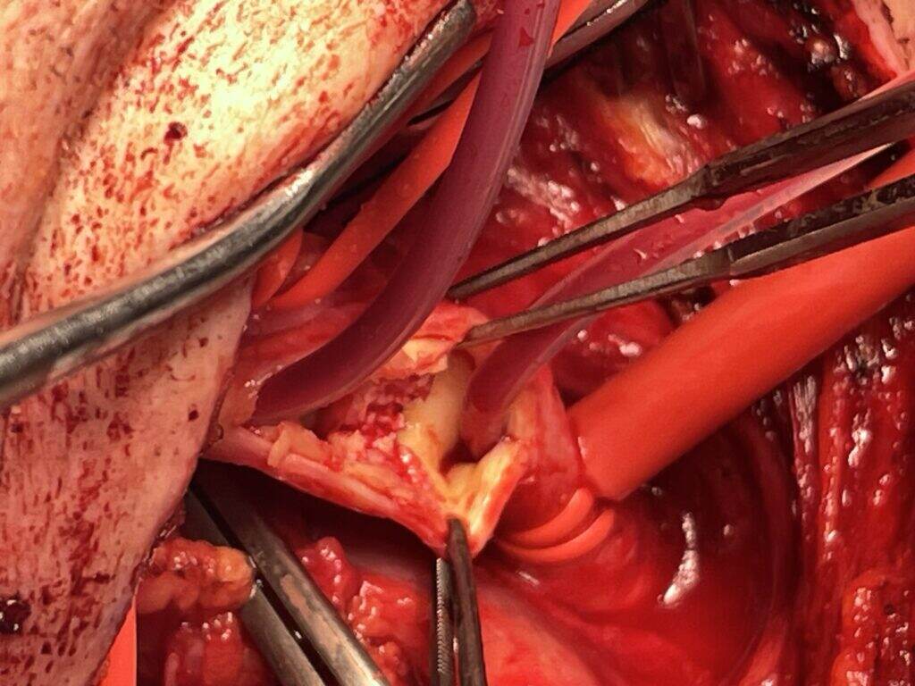 The artery opened, revealing the stroke-causing blockage.