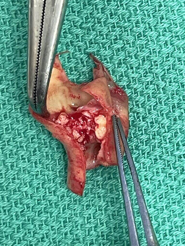 The blockage removed.