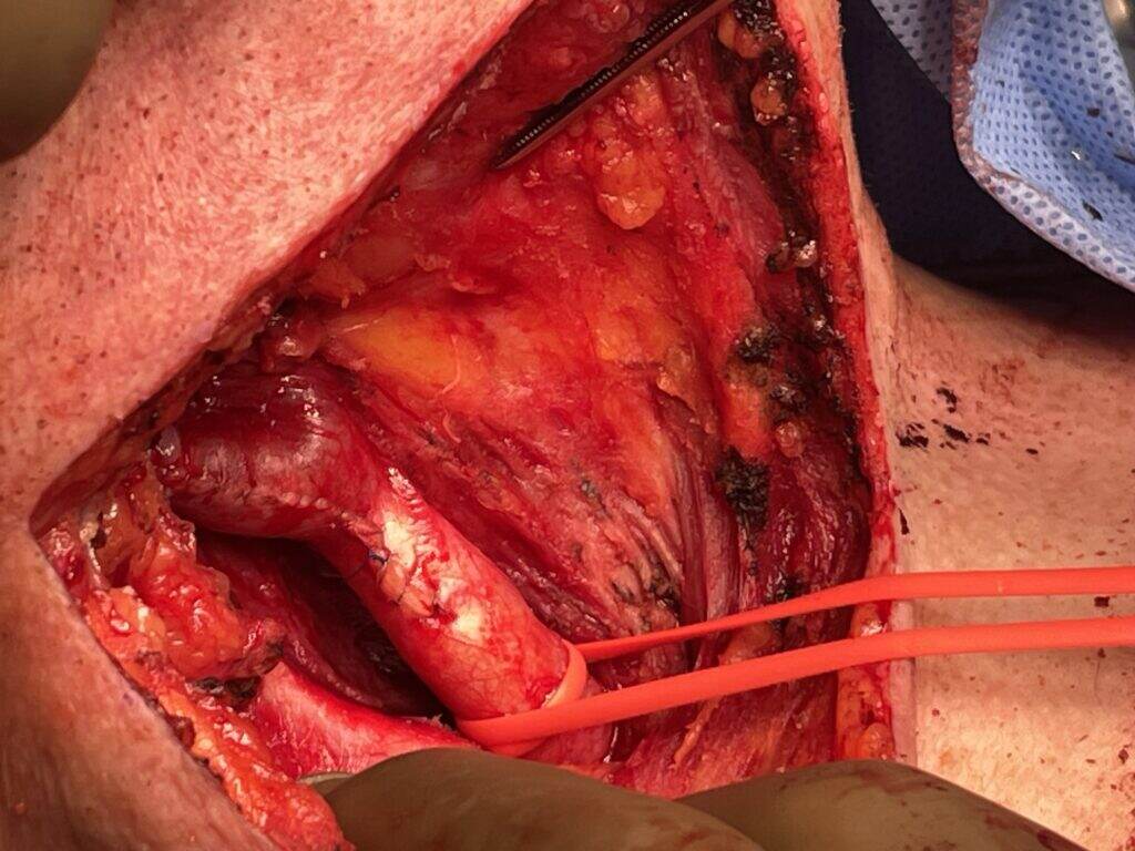 The artery after it has been stitched closed.
